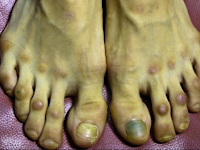 WASPADALAH!! Jika Ada 10 Tanda Ini Di Kaki Segera Periksakan Ke Dokter!