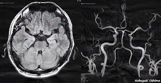 脳のMRI、MRA検査画像