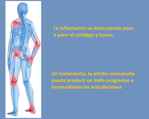 Artritis Reumatoides