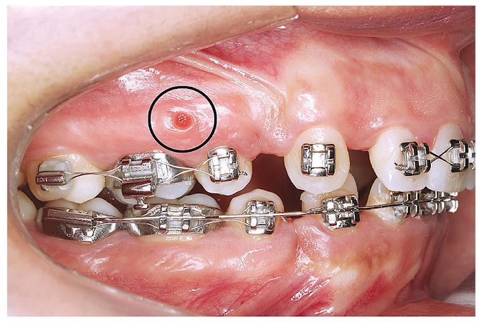 PDF: Analysis of Factors Associated with Orthodontic Microscrew Failure