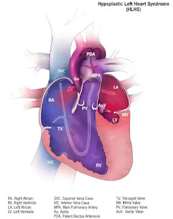What is Congenital Heart Disease In Adults