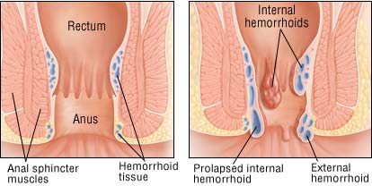 TREATMENT OF HEMORRHOIDS AT HOME: ONE INGREDIENT AND YOU’RE CURED!