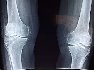 arthritis knee x-ray