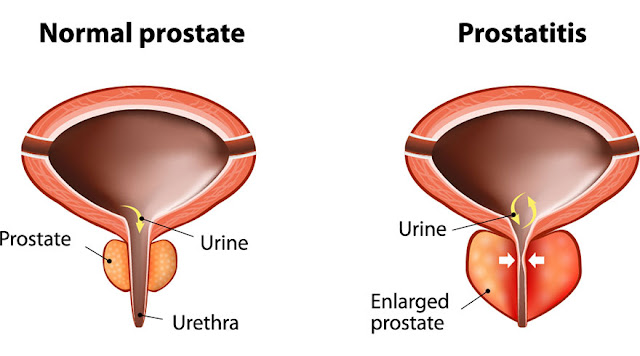 What Can Be Done To Improve Prostate Health?