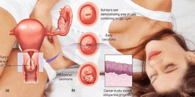 Cervical Cancer - Symptoms, causes and treats