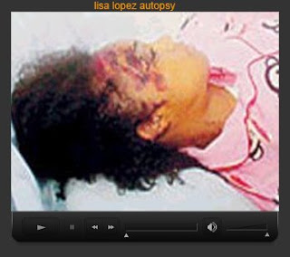 Celebrity Autopsy Pictures on Lisa Lopes Autopsy   Left Eye Autopsy