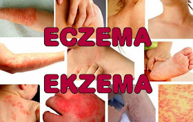 Ekzema-eczema