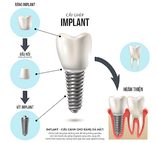 Quy trình cấy ghép răng implant