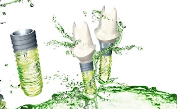 Đặc điểm của trồng răng implant
