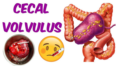 Cecal volvulus, Cecal bascule