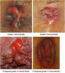 wasir luar obat herbal wasir