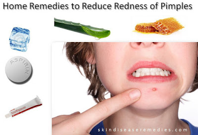 home-remedies-for-pimple