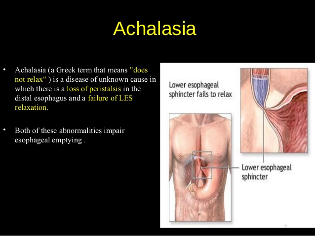 Achalasia