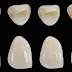 Phục hình răng sứ Cerec cho răng hàm đẹp