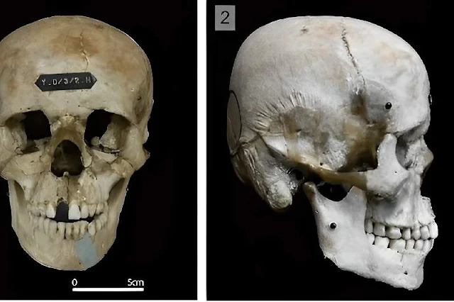 Explorando la práctica de deformación intencional de cráneos en las antiguas tribus japonesas: una mirada profunda a la identidad cultural y social a través de los restos óseos