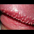 Kutil Di Daerah Anus thumbnail