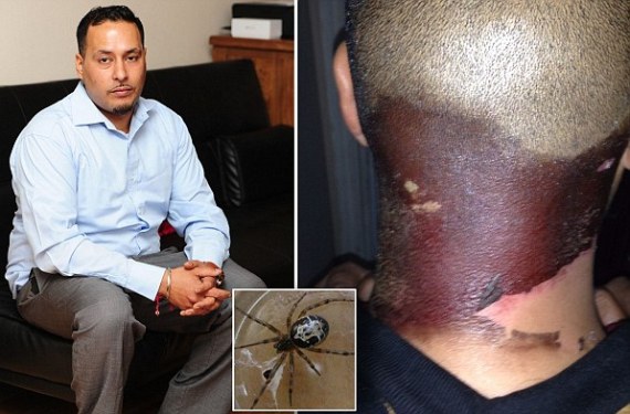 Photos: What! See what a false widow spider did to this man