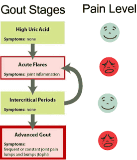 Ketahui Diagnosis dan Kaedah Rawatan Untuk Gout  Cerita 