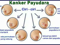 Gejala Kanker Payudara Laki-Laki