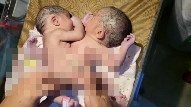 Bayi Kembar Siam Lahir di Asahan, Dempet di Bagian Perut