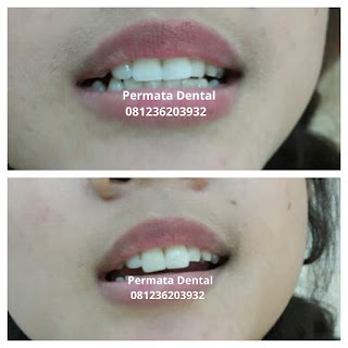 gambar foto contoh veneer gigi kelinci buatan manis cantik bali jember banyuwangi murah berkualitas di PERMATA DENTAL gambar gigi rusak yang di veneer gigi yang tidak rapi gigi renggang gigi patah cuil rompal pendek karies hitam kuning