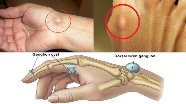 Cara Pengobatan Benjolan di Tangan atau Kaki