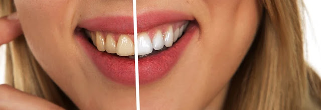 How to whiten your teeth