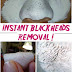 Say Goodbye Blackheads in 15 Minutes!