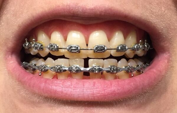 Răng bị vàng khi niềng? Cách khắc phục vàng răng khi niềng