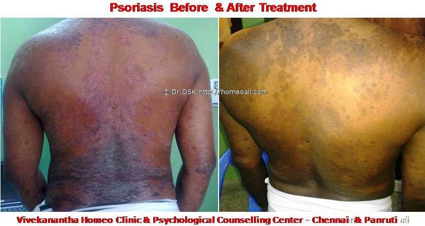 Psoriasis - சொரியாசிஸ்  சொரியாசிஸ்  - Psoriasis  என்றால் என்ன ? சொரியாசிஸ் என்பது தோல் அழற்சி நிலையாகும். இதை மீன் செதில் படை என்றும் அழைக்கலாம்.   சொரியாசிஸ் தோலில் உள்ள செல்கள் வேகமாக இறப்பதன் மூலம் உண்டாகிறது.  இதன் விளைவாக தோல் தடித்து மீன் செதில் போன்று இறந்த செல்கள் உதிரும், புரையோடும். தோலிலுள்ள பல சிறு இரத்த நாளங்கள்  வீங்கிவிடுவதால்  தோல் சிவப்பு நிறமாகக் காணப்படும்.  சொரியாசிஸ் எவ்வாறு தோற்றமளிக்கும்? • சொரியாசிஸ் என்பது தோலில், மீன் செதில் போன்று இறந்த செல்கள் உதிர்ந்து விழும் புரையுடன் கூடிய வெண்மை / சிவப்பு திட்டுகளாக (Silver Scaly patches) காணப்படும். • உடலின் எந்தப்பாகத்தில் வேண்டுமானாலும் வரலாம். • முழங்கை, முழுங்கால் மூட்டு, முதுகு, தலையுச்சி முதலிய பாகங்கள் பொதுவாக பாதிக்கப்படும்.  சொரியாசிஸ் தொற்று நோயா? • சொரியாசிஸ் தொற்று நோயல்ல. இது மற்றவர்களுக்கு பரவாது • சுகாதார குறைவு காரணமாக இது ஏற்படாது.  சொரியாசிஸ் வர காரணம் என்ன ? • சொரியாசிஸ் மரபு காரணம் மற்றும் சுற்றுச் சூழல் நிலை இவற்றின் பாதிப்பினால் ஏற்படுகிறது என்று நம்பப்படுகிறது. • சொரியாசிஸால் பாதிக்கப்படுபவர்களில் 25% பேர் சொரியாசிஸ் நோயுடைய குடும்பத்திலிருந்து வந்தவர்களே, சிலருக்கு மரபு நிலை காரணமாகிறது. • உடல், மன அழுத்தங்கள், குரல்வளை தொற்று, ப்ளூ, ஸ்டீராய்ட் ஹார்மோன்ஸ், சில ஆண்ட்டி ஹைபர் டென்சிவ்  போன்ற சில மருந்துகள், சோரியாசிஸை மேலும் மோசமாக்கும். • குடிபழக்கம், புகைபிடித்தல் சொரியாசிஸை மோசமாக்கும்.  சொரியாசிஸ் நோயின் விளைவுகள் • சொரியாசிஸ் நோயாளிகளுக்கு மூட்டுவலிகளும், வீக்கமும் வரலாம். • சொரியாசிஸ் விரல்களையும், கால்விரல் நகங்களையும் தாக்கி, சிறு குழிகளையும், கருமை நிறத்தையும், நகங்கள் தடிப்பையும், ஏற்படுத்தும். நகம் உடையலாம்.  சொரியாசிஸ் யாருக்கு வரும் ? • சொரியாசிஸ் ஆண், பெண் இருவரையும் சமமாகத் தாக்கலாம். • சொரியாசிஸ் எந்த வயதில் வேண்டுமானாலும் வரலாம். வழக்கமாக 20 வது வயதில் தாக்கத் தொடங்கும். பிறப்பிலிருந்தும் முதிய வயதிலும் கூட இது வரலாம். • ஒரு முறை சொரியாசிஸ் வந்ததும், குறைதல், தணிதல், அதிகரித்தல் என பல்வேறு நிலை மாற்றங்கள் ஏற்படும்.  சொரியாசிஸ்க்கு என்ன மருத்துவங்கள் உள்ளன. நவீன மருத்துவத்தில் பல மருந்துகள் உபயோகப்படுத்தப்படுகின்றன, டாபிகல் ஸ்டீராய்ட்ஸ்  மேற்பூச்சுக்கள் (Steroids creams), போட்டோதெரபி, அல்ட்ரா வைலட்,  மெதாட்டுரக்ஸாட் (methotrexate) இத்தகைய மருந்துகள் பக்க விளைவுகளை ஏற்படுத்தும். எனவே நோயாளிகள் இந்தப் பக்க விளைவுகளைப் பரிசோதித்துக் கொள்ள அடிக்கடி இரத்த பரிசோதனை செய்து கொள்ள வேண்டும். மேலும் தொடர்ந்து இந்த மருந்துகளை உட்கொள்ளக்கூடாது.   சொரியாசிஸ் நோயாளிகள் செய்யக்கூடாதவை, செய்ய வேண்டியவை  தோலைச் சொரியாதீர்கள் ஏனெனில் இது குணமாவதைத் தாமதப்படுத்தும்.  ஹோமியோபதி மருந்துகள் வேலை செய்து விளைவுகள் காட்ட பல வாரங்கள் ஆகுமாதலால் மருத்துவத்தை விரைவில், இடையில் நிறுத்திவிடாதீர்கள்.  சொரியாசிஸைக் கட்டுப்படுத்த  தரப்பட்ட மருந்துகளையும், மருத்துவத்தையும் திடீரென்று நிறுத்திவிடாதீர்கள். இதனால் நோய் இன்னும் மோசமாகும்.  மருந்துகளை தொடர்ந்து சீராக எடுத்துக்கொள்ளுங்கள்.  தோலை எப்போதும் ஈரத்தன்மையுடையதாக வைத்திருங்கள். அது நமைச்சலையும், அரிப்பையும், புரை ஏற்படுவதையும் தடுக்கும்.  சூரிய ஒளியில் இருப்பது பொதுவாக நல்லதே, ஆனால் அதிகமாக வெகு நேரம் இருப்பதால் வேர்க்குருக்கள் உண்டாகும். அதனால் சொரியாசிஸ் தீவிரமடையும்.  மன அழுத்தம் சொரியாசிஸை அதிகப்படுத்தும். அமைதியாக இருக்கவும், உடற்பயிற்சி செய்யவும், ஒய்வு எடுத்துக்கொள்ளவும்,    சோரியாஸிஸ் ஹோமியோபதி மருத்துவ சிகிச்சை, நோயின் அறிகுறிகளுக்கேற்ற ஹோமியோபதி மருத்துவசிகிச்சை நோயின் தன்மையை நன்கு கட்டுப்படுத்தி விரைவில் நல்ல பலனளிக்கும். தொடர்ந்து ஹோமியோபதி மருந்துகளை உட்கொள்வதன் மூலம் நல்ல பலன்பெறலாம்.       ஹோமியோபதி சிகிச்சைக்கு தொடர்பு கொள்ளவும் ஹோமியோபதி சிறப்பு மருத்துவர் செந்தில் குமார் தண்டபாணி அவர்களிடம் இதைப்போன்ற  நோய்களுக்கு சிகிச்சை பெற்று பலர் நல்ல பலனடைந்திருக்கிறார்கள். மருத்துவர் செந்தில் குமார் அவர்களை சென்னை, வேளச்சேரி விவேகானந்தா ஹோமியோபதி கிளினிக் & உளவியல் ஆலோசனை மையத்தில் சந்திக்கலாம். முன்பதிவு அவசியம். முன்பதிவிற்கு தொடர்புகொள்ளவும் 9786901830, மின் அஞ்சல்: consult.ur.dr@gmail.com       மேலும் விபரங்களுக்கும் ஆலோசனைக்கும் சிகிச்சைக்கும் தொடர்பு கொள்க விவேகானந்தா கிளினிக் ஆலோசனை மையங்கள் & தொடர்பு எண்கள் சென்னை:- 9786901830  பண்ருட்டி:- 9443054168  புதுச்சேரி:- 9865212055 (Camp) மின் அஞ்சல் : consult.ur.dr@gmail.com, homoeokumar@gmail.com   முன்பதிவிற்கு அழைக்கவும் அல்லது மின் அஞ்சல் அனுப்பவும்.  முன்பதிவிற்கு: உங்களின் பெயர் - வயது – அலைபேசி எண் – பிரச்சனை (ஒரு வரியில்) தேதி – கிழமை – இடம், முதலியவற்றை குறுந்தகவல் மூலம் அனுப்பவும். உதாரணம்: ரம்யா - 28 – 99******00 – சோரியாசிஸ் Psoriasis – 20-12-2014 – சனிக்கிழமை – சென்னை, மருத்துவர் உங்களின் முன்பதிவை குறுந்தகவல் மூலம் உறுதிப்படுத்துவார்.