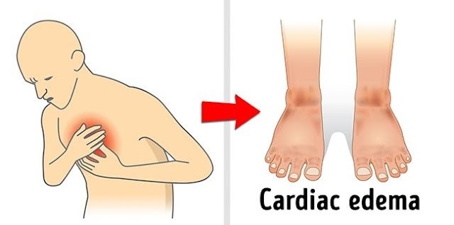 Pembengkakan kaki dan perut bisa menandakan penyakit jantung