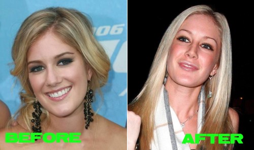 heidi montag before and after 10 surgeries. heidi montag before and after