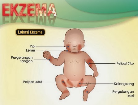 Mengapamasin.com: ekzema dengan masin garam