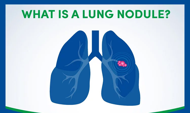 What is a Lung Nodule? 