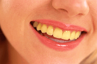 10 Causes of Yellow Teeth