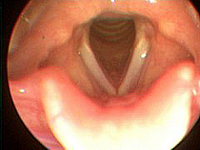 Eastside Family Health Center: Hoarseness