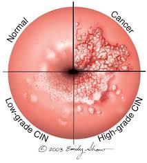 HPV Menular