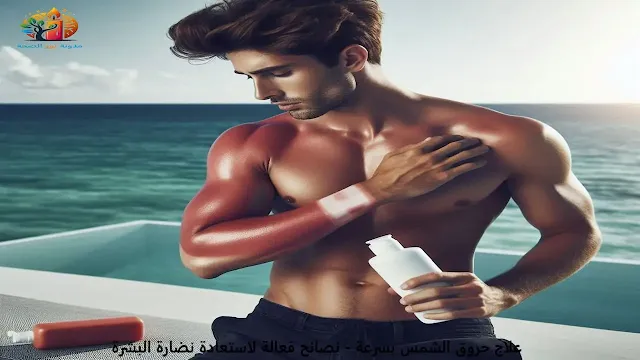 علاج حروق الشمس بسرعة