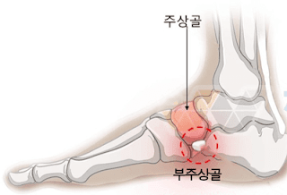 부주상골 증후군 설명 사진