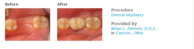 View Dental Implants Before and After Photos  