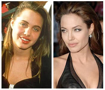 Angelina Jolie Plastic Surgery