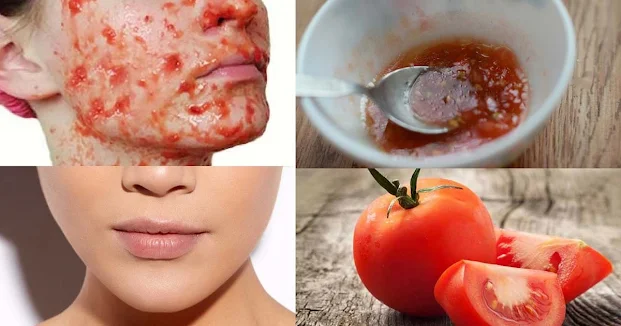 Tomatoes for dark spot: Natural Remedies To Get Rid of Dark Spots