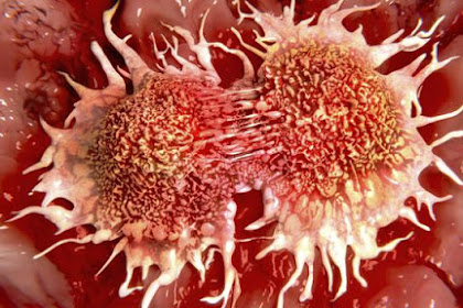 Cara Mencegah Kanker Yang Wajib Diketahui