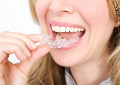 Trường hợp nào đeo hàm duy trì sau niềng răng?