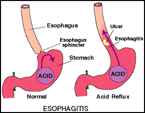 symptom of acid reflux disease gastro esophageal reflux disease 