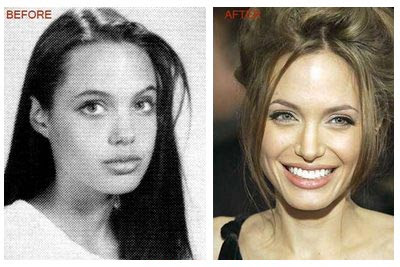 Angelina Jolie Chin Implant