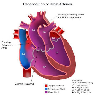 TRANSPOSITION OF GREAT ARTERIES