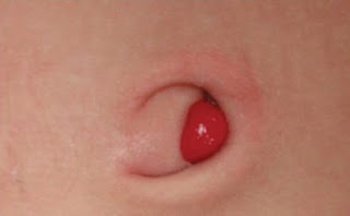 Umbigo do bebé - granuloma umbilical (tecido de granulação)