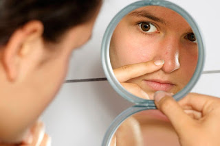 como quitar el acne de la nariz