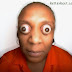 See Scary Photos Of Woman With The World’s Biggest Eyes